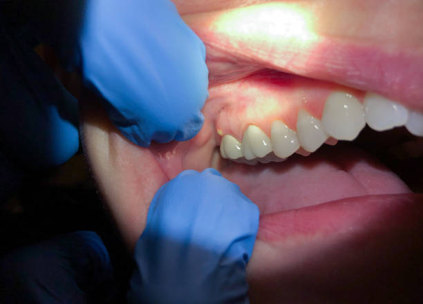 Best Same-Day Emergency Dental Services in Liolnton, NC